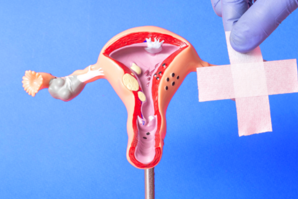 20 perguntas e respostas sobre endometriose